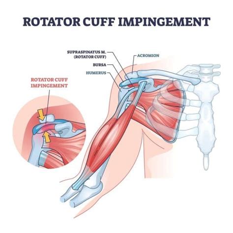 Understanding Shoulder Impingement Causes Symptoms And Treatment