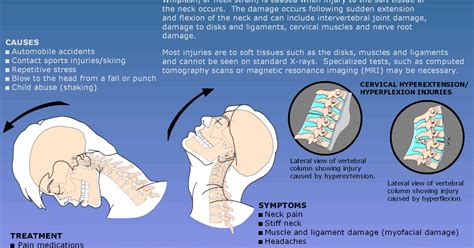 Whiplash Injury