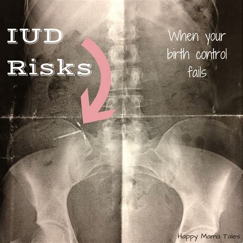 Facing the Reality of IUD Risks - Happy Mama Tales