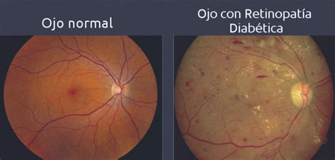 Como evitar ceguera por diabetes Oftalmólogos Martinez de Carneros Madrid