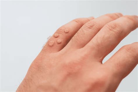 Wart Removal In Scottsdale And Paradise Valley