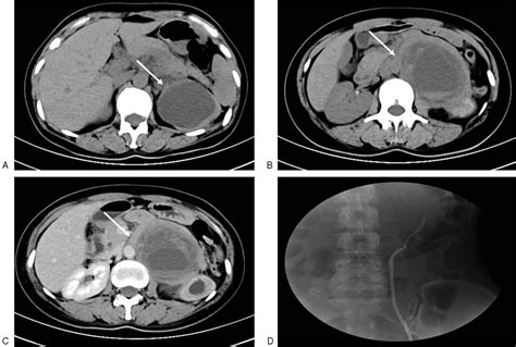 Surgical Management Of Retroperitoneal Schwannoma Complicate Medicine