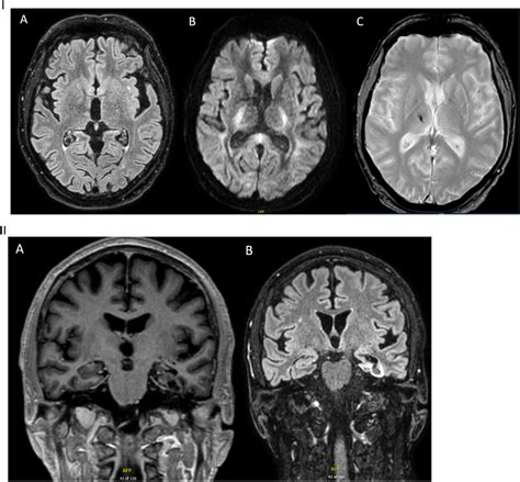 Covid Associated Acute Asymmetric Hemorrhagic Necrotizing