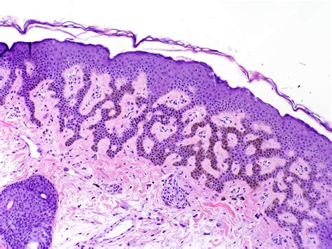 Irritated Seborrheic Keratosis Histology