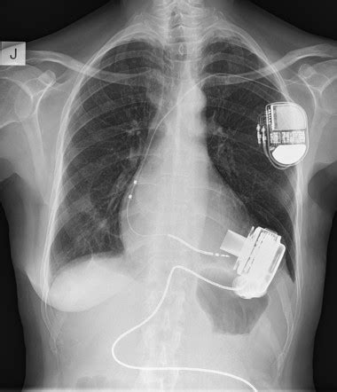 Left ventricular assist device (LVAD) | Radiology Case | Radiopaedia.org