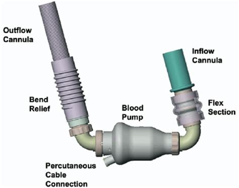 External View Of Heartmate Ii Left Ventricular Assist Device