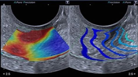 Shear Wave Elastography Swe Indicative Of Overpressure Peripheral Download Scientific