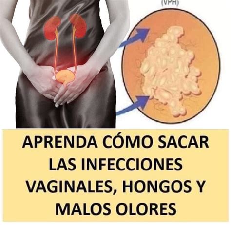 Como Eliminar Las Infecciones Vaginales Y Todos Sus Hot Sex Picture