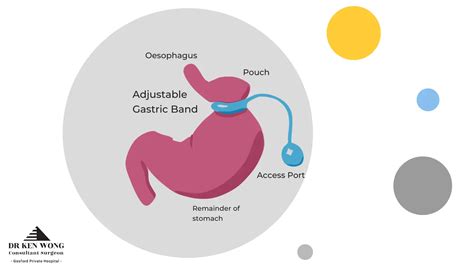 Lap Band Surgery Cost Australia | Gastric Band Surgery Cost Explained