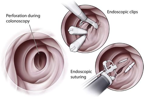 Endoscopic Management Of Colonic Perforations Clips Versus Suturing Closure With Videos