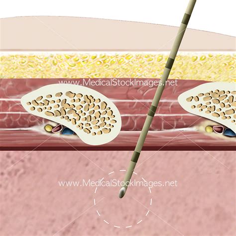 Close up View Biopsy Needle in Lung – Medical Stock Images Company