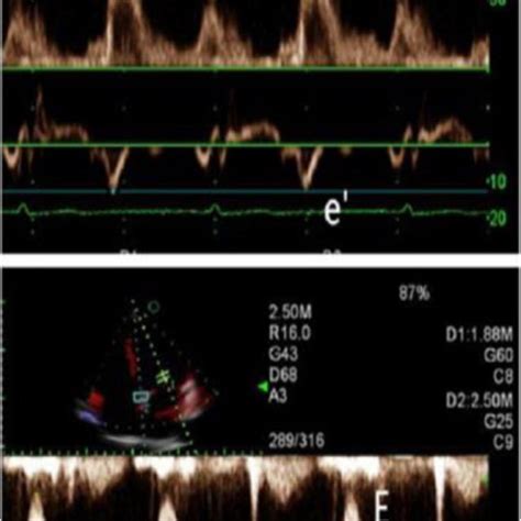 Measurement Of Transmitral Inflow And The Mitral Annular Velocity Using