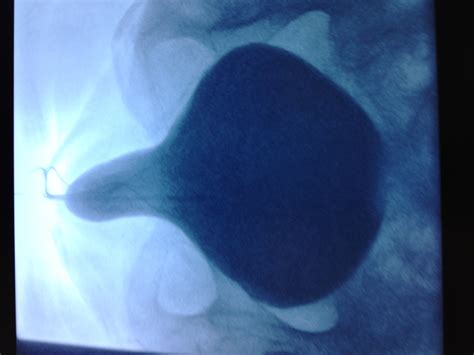 Cystogram Cystocele Grade Three