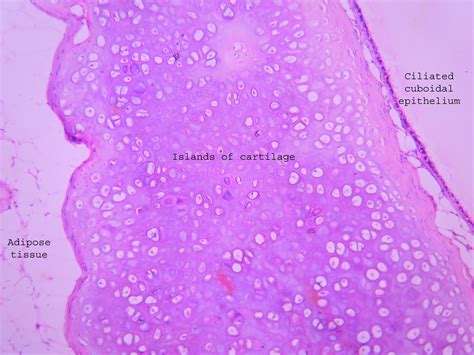 Dermoid Cyst Ovary Histopathology Guru