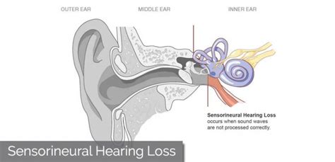 Sensorineural Hearing Loss - Get Best Treatments & Diagnosis