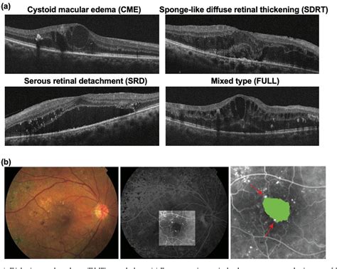 Figure 1 From Factors Affecting A Short Term Response To Anti Vegf Therapy In Diabetic Macular