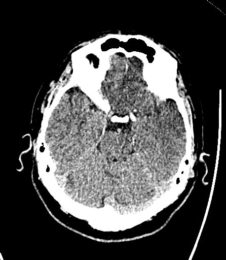 File Acute Ischemic Stroke Hyperdense Ica Mca And Aca Radiopaedia 96456 116185 Axial 11 Png