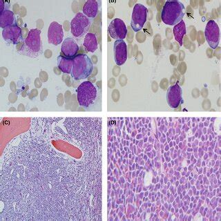 Peripheral blood smear showing: (A) marked pancytopenia. (B and C) Rare... | Download Scientific ...