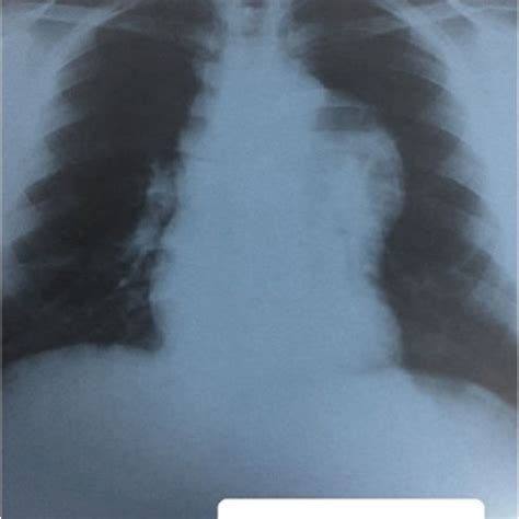 -Preoperative chest X-ray. | Download Scientific Diagram