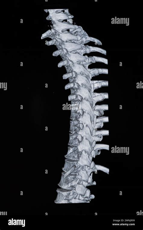 Spinal mri images Stock Photo - Alamy