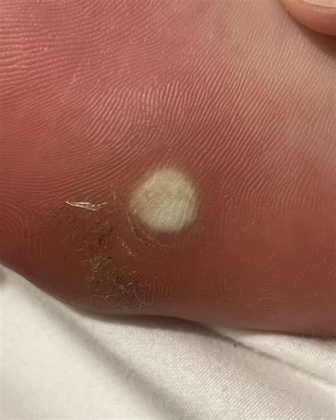 Is my wart gone? : r/Warts