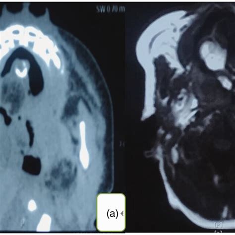 Representative Preoperative Computed Tomography A And Magnetic