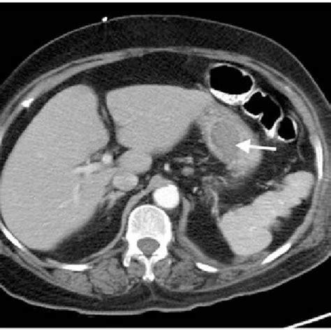 (A) Gastric submucosal lesion (leiomyoma) identified during endoscopy ...