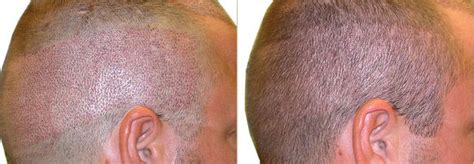 Follicular Unit Extraction Fue Hair Transplant Nyc Ny Hair Loss