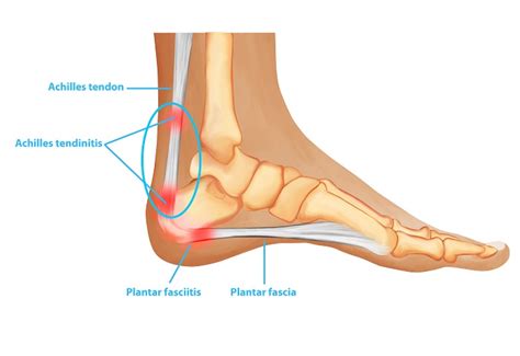 Heel Bursitis: What Does It Mean And What Should You Do? | atelier-yuwa ...