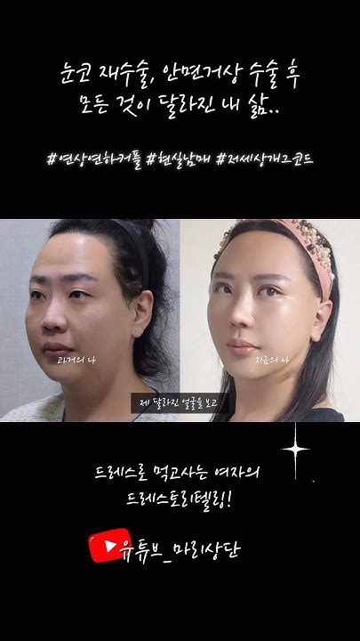 눈코 재수술과 안면 거상 성형수술 후 모든 것이 달라진 내 삶 복코수술 복코성형 얼굴지방흡입수술 얼굴지흡 Youtube