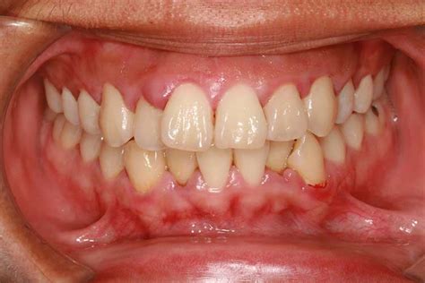 7 Common Signs and Symptoms of a Tooth Cavity | Absolute Dental