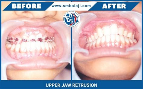 Upper Jaw Retrusion: Causes, Symptoms, and Treatment Options