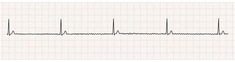 Ekg Monitor Showing Regularized Atrial Fibrillation Or Af With Block