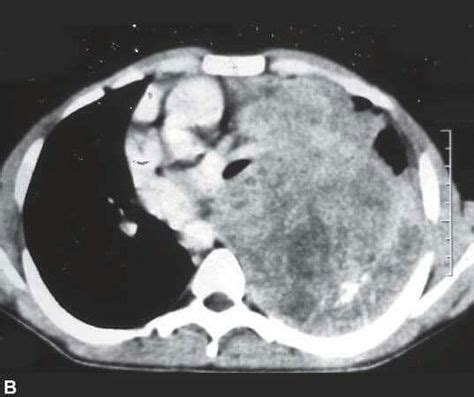 Pleuropulmonary blastoma | Radiology