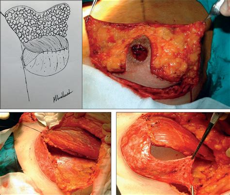 Mastectom A Ahorradora De Piel Tipo Iv Con Injerto Libre De Areola