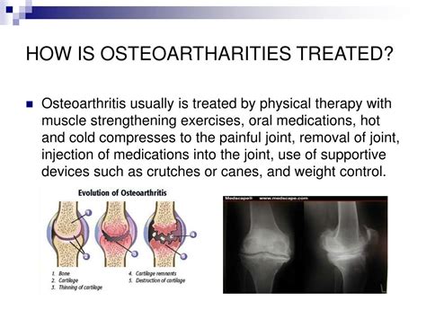 Ppt Osteoarthritis Powerpoint Presentation Free Download Id 5131778