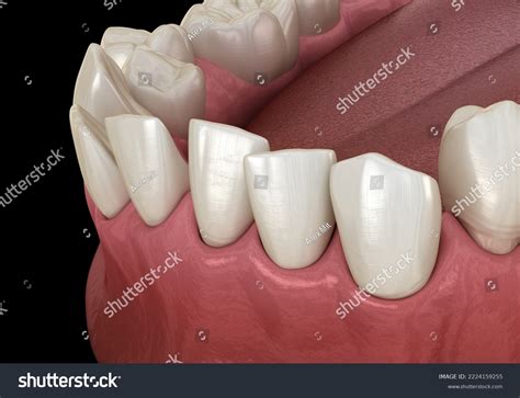 Overcrowded Teeth Abnormal Dental Occlusion Medically Stock