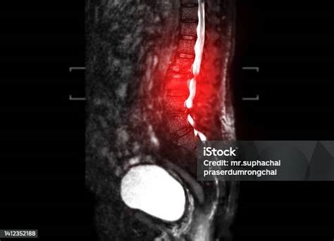 Mri Lumbar Spine Sagittal View Stock Photo - Download Image Now ...