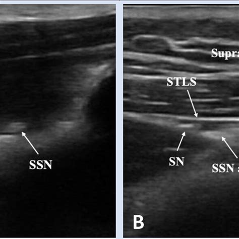 Ultrasonographic Evaluation Of Scapular Notch A Type II Right Sided