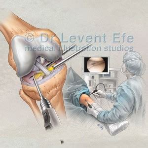 Knee Arthroscopy And Meniscus Repair Dr Efes Medical Art Store