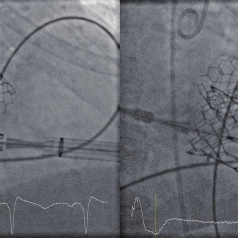 Valve In Ring Mitral Valve Implantation A Positioning Of The Crimped