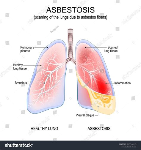 Asbestosis Lungs Inflammation Scarring Lungs Due Stock Vector Royalty