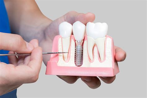 Dental Implants In Louisville Ky Harmon Dental Center