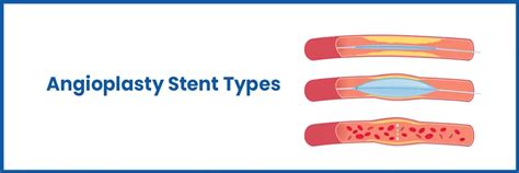 Angioplasty Stents Types And Post Care