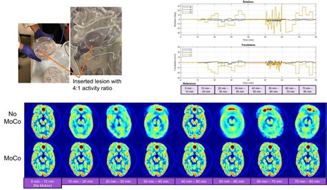 Evaluation Of Pet Data Driven Motion Correction In The Brain Using The