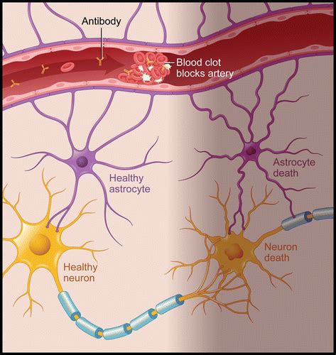 Central Nervous System Systemic Lupus Erythematosus Pathophysiologic