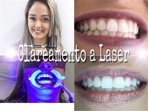 Clareamento Dental A Laser Youtube