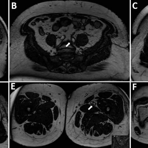 Balanced Steady State Free Precession Magnetic Resonance Venography Of