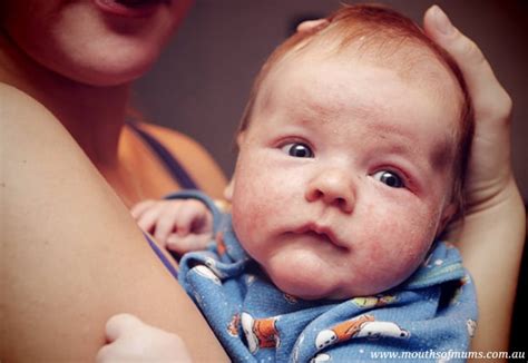 Childhood Eczema Explained Mouths Of Mums