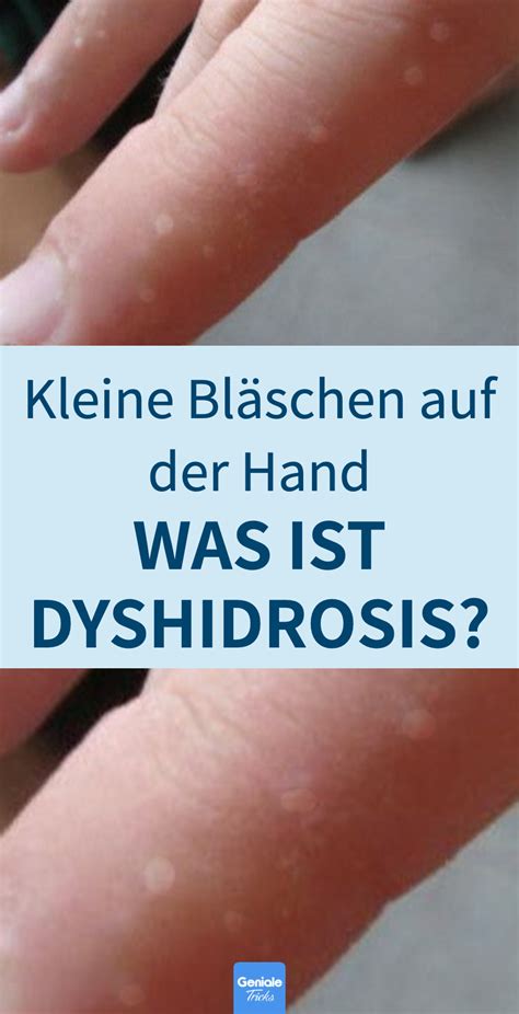 Dyshidrotisches Ekzem Was Hilft Gesundheit Und Wohlbefinden Ekzem